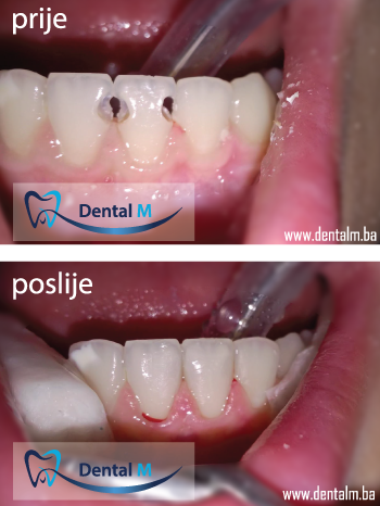 Prednji zubi prije i poslije popravke